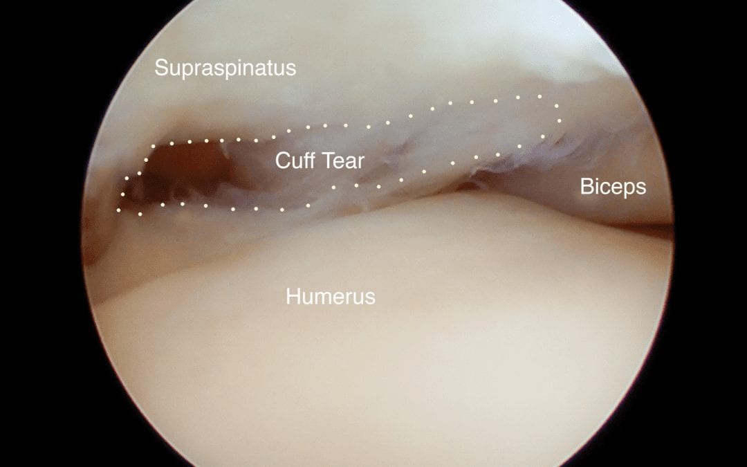 Rotator cuff tear – When is Surgery Warranted?