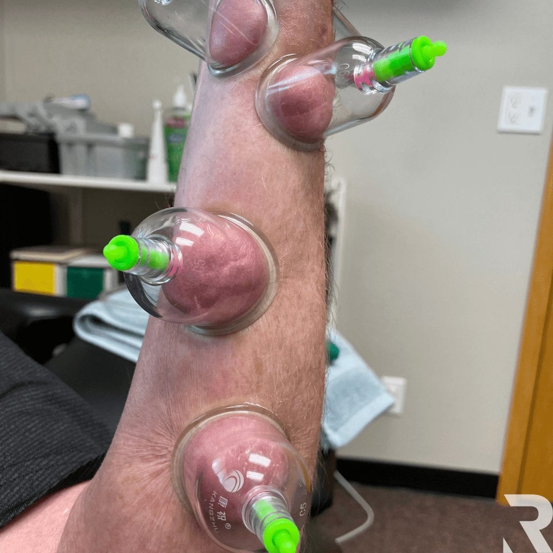 carpal tunnel cupping