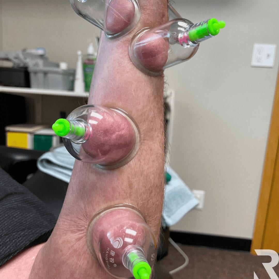 carpal tunnel cupping carpal tunnel cupping