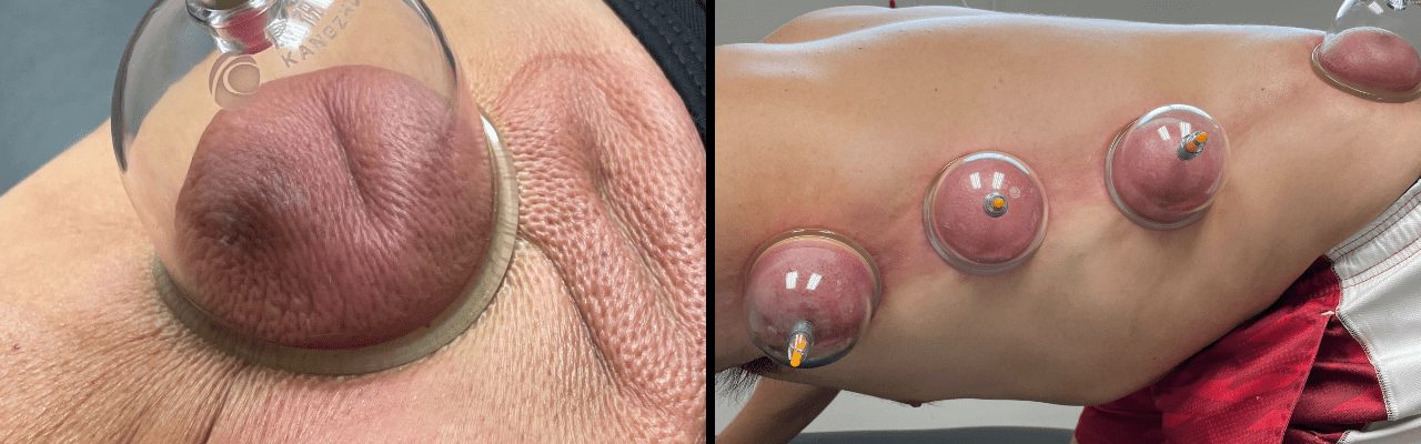 cupping cupping
