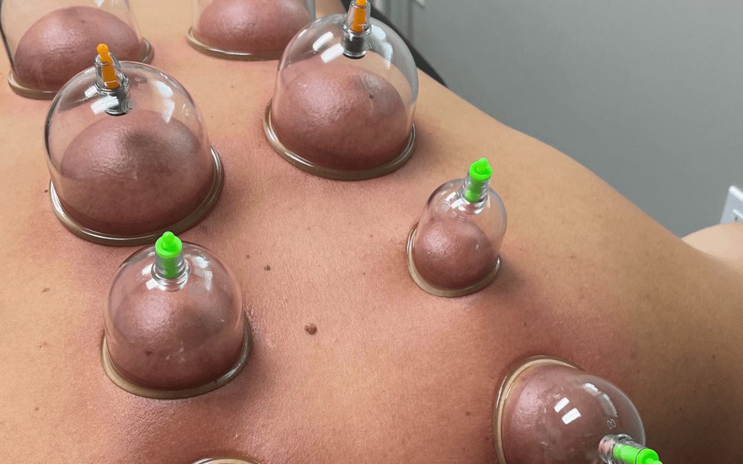 Cupping – What the Cup is it?