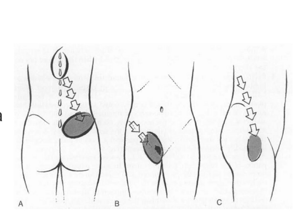 Pattern of left flank pain from the thoracolumbar junction syndrome.