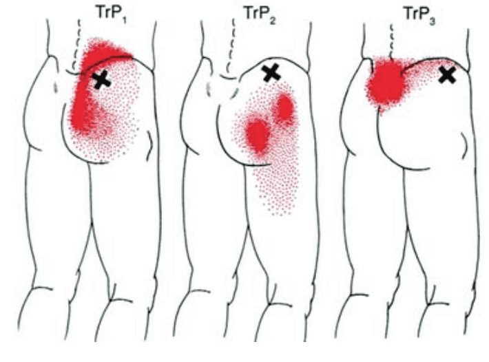 greater trochanteric hip pain