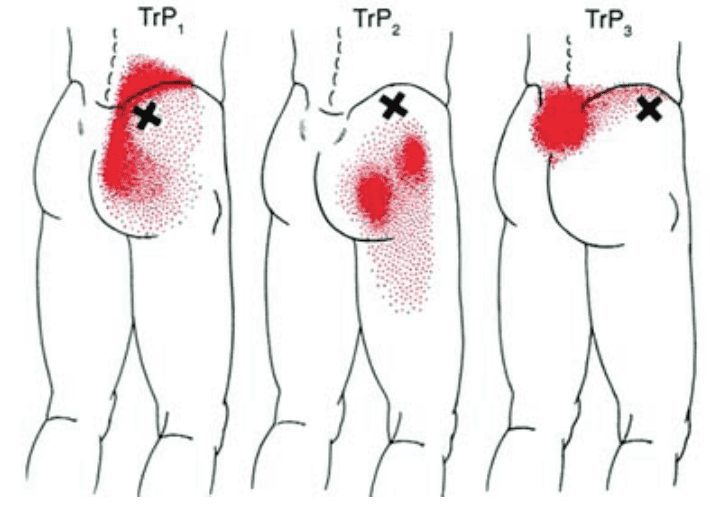 greater trochanteric hip pain greater trochanteric hip pain