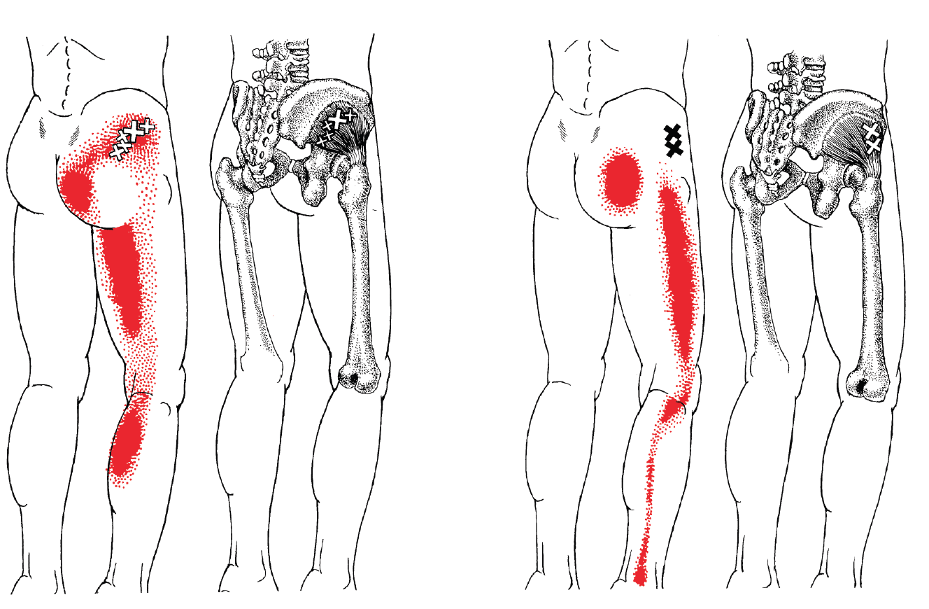 greater trochanteric pain - gluteus minimus greater trochanteric pain - gluteus minimus