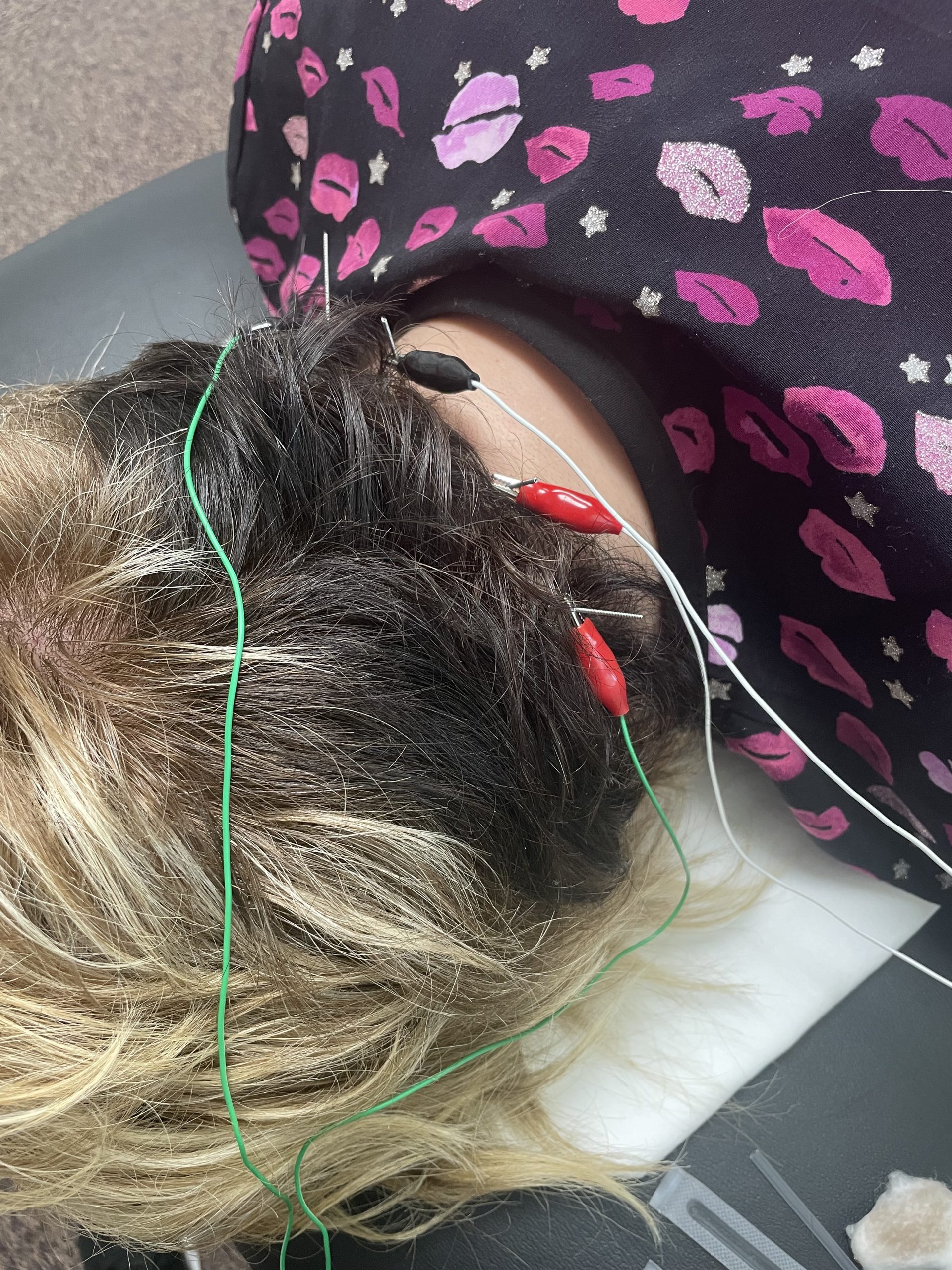 migraine dry needling migraine dry needling