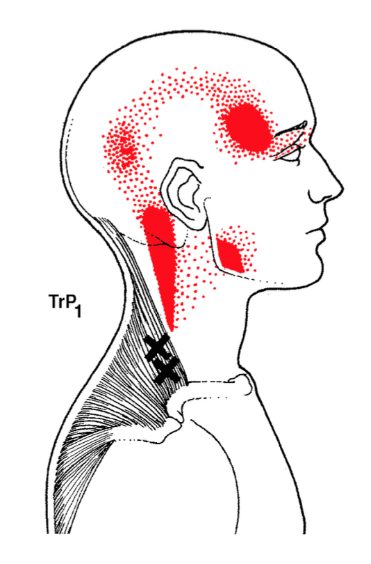 Screen Shot 2022-03-07 at 11.06.06 AM trigger point - headache