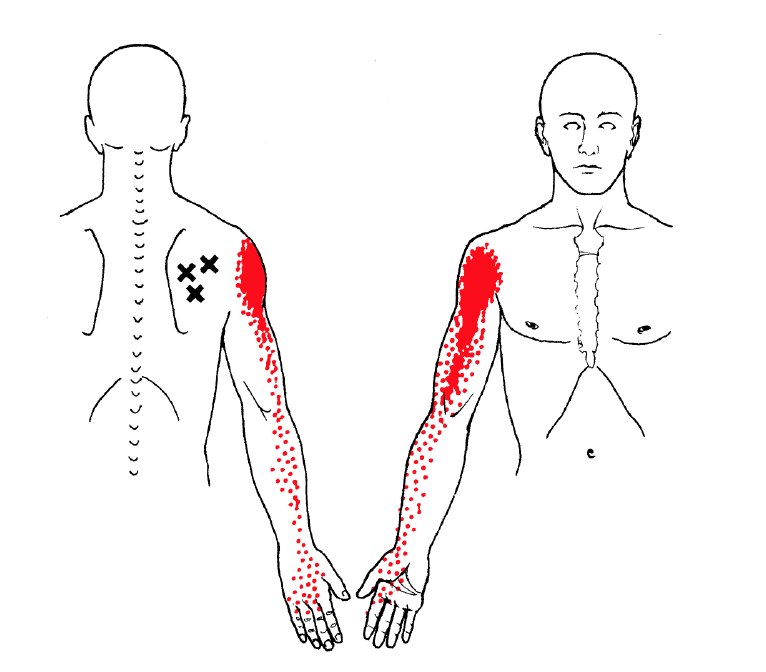 Screen Shot 2022-03-15 at 3.11.44 PM trigger point infraspinatus