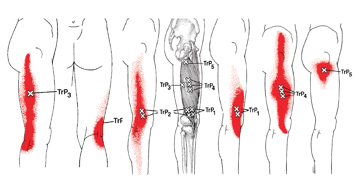 Screen Shot 2022-03-15 at 3.15.14 PM trigger point - ITB Syndrome