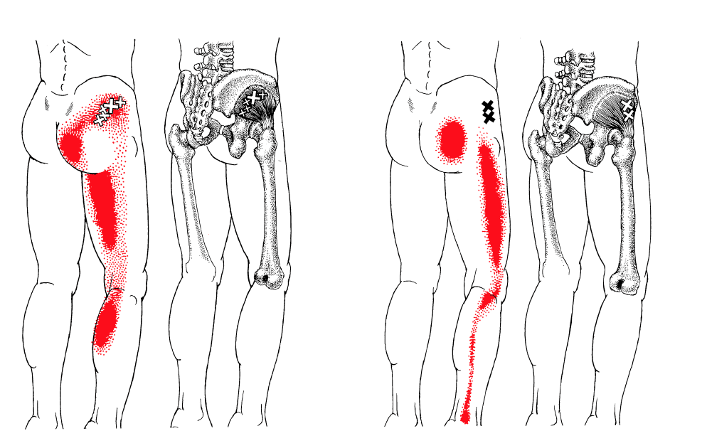 Screen Shot 2022-03-15 at 3.26.28 PM trigger point - hip pain
