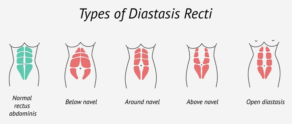 diastasis recti diastasis recti