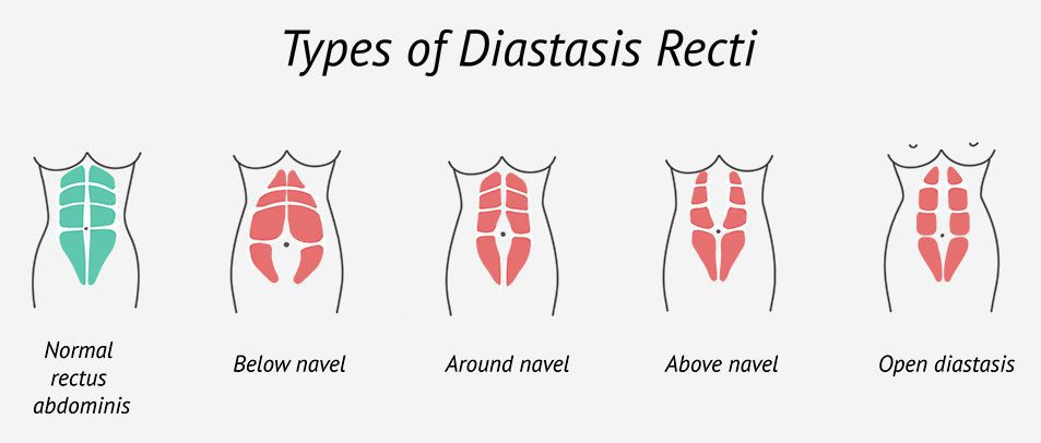 One month postpartum diastasis update after baby #2 and Bellies Inc  postpartum recovery belly system