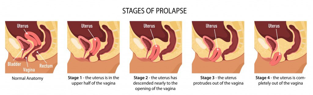 stages of prolapse