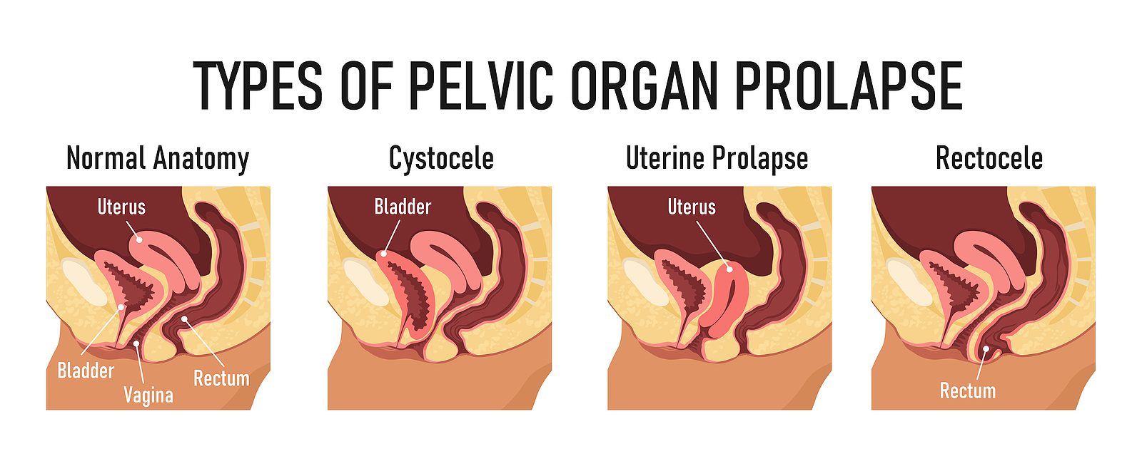 prolapse types prolapse